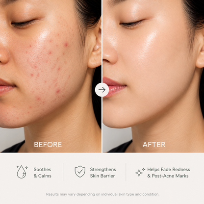Breakout Recovery Cream